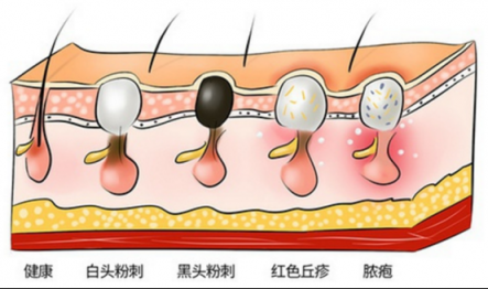 黑头仪有用吗？这么多款去黑头的方法就属它最有效