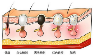 HomeFacialPro乳糖酸去黑头鼻贴膜全新上市 抑制顽固黑头反复上演