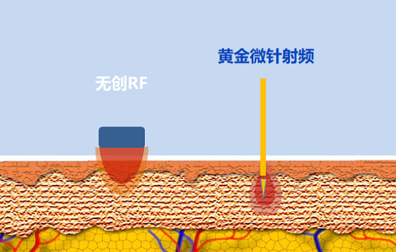 抗衰选热玛吉还是黄金微针？看老司机全面解读！