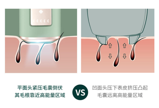 Ulike蓝宝石脱毛仪：打开无痛脱毛新世界大门