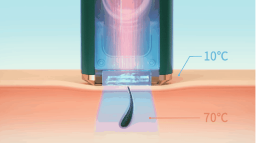 Ulike蓝宝石脱毛仪：打开无痛脱毛新世界大门