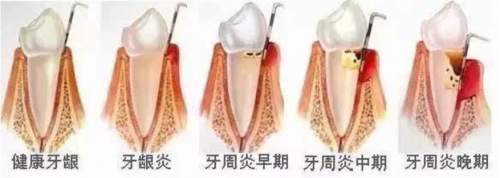 小米有品众筹超10000000！素诺智能可视洁牙仪T11Pro为何一炮而红？